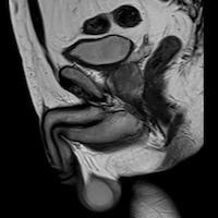 МРТ яичек у мужчин снимок 